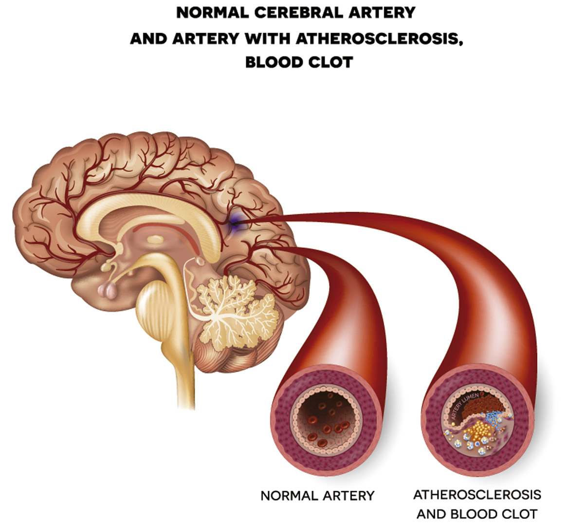 Diagrama del accidente cerebrovascular (ACV) isquémico