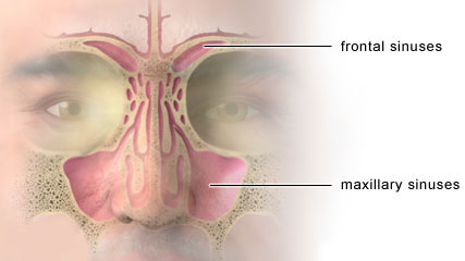 sinusitis
