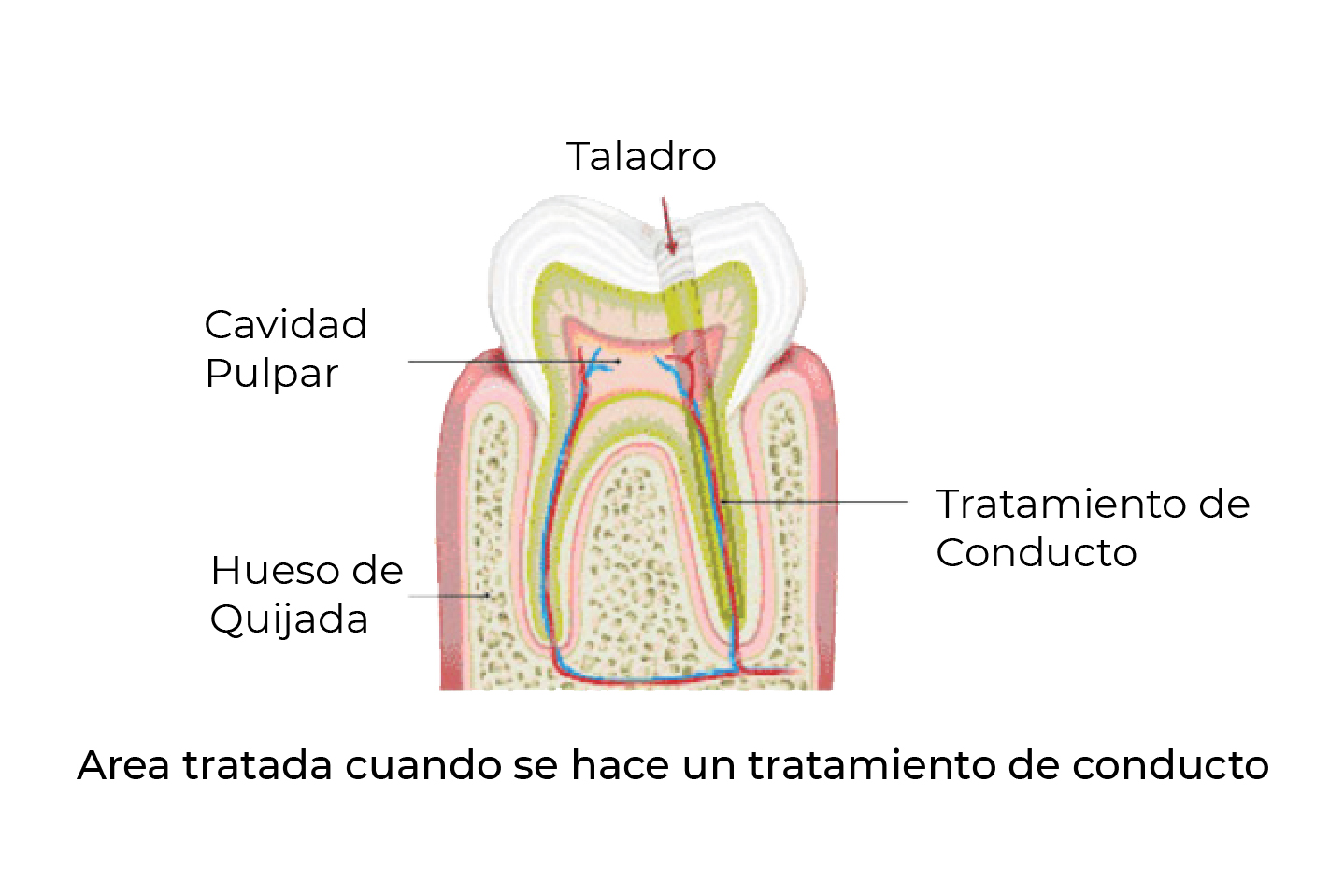 Gráfica de pieza dental mostrando donde se aplica el tratamiento de conducto