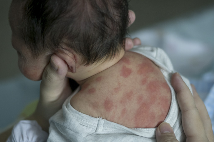 Recién nacido con manchas rojas en la piel