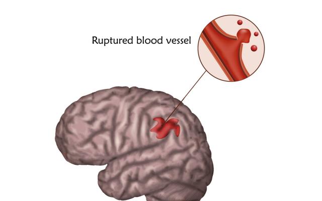Diagrama del accidente cerebrovascular (ACV) hemorrágico