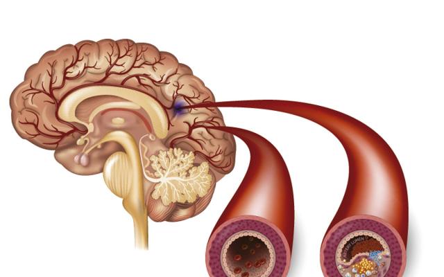 Infarto cerebral: la segunda causa de discapacidad en México; cada año ...