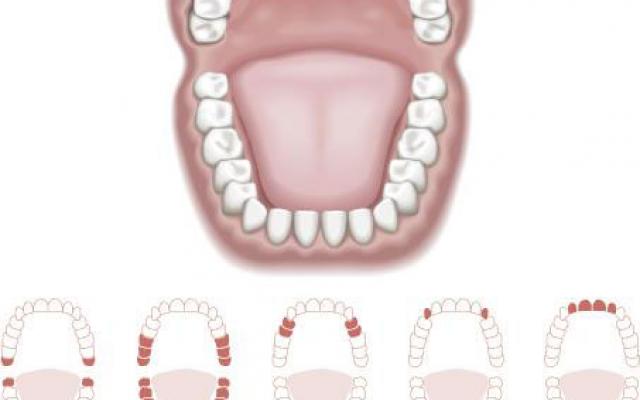 Muelas del juicio y resto de dientes en un diagrama de una boca