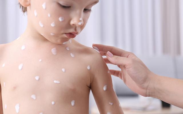 Aplicando crema a niño con varicela