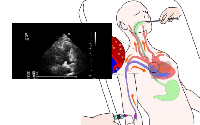 Diagrama de un ecocardiograma transesofágico aplicado a un paciente