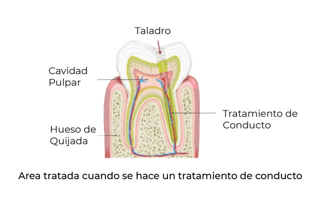 Gráfica de pieza dental mostrando donde se aplica el tratamiento de conducto
