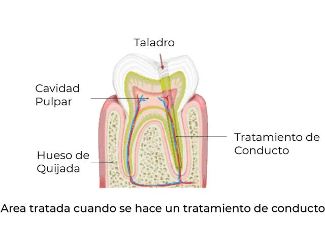 Gráfica de pieza dental mostrando donde se aplica el tratamiento de conducto