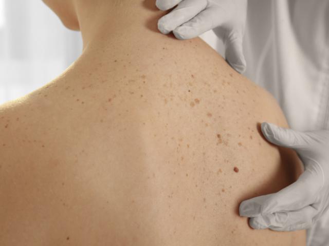 Persona con manchas marrones en la espalda