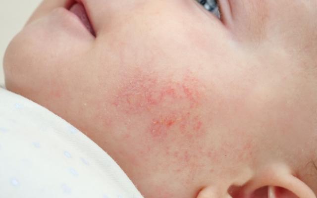 Bebé con dermatitis atópica