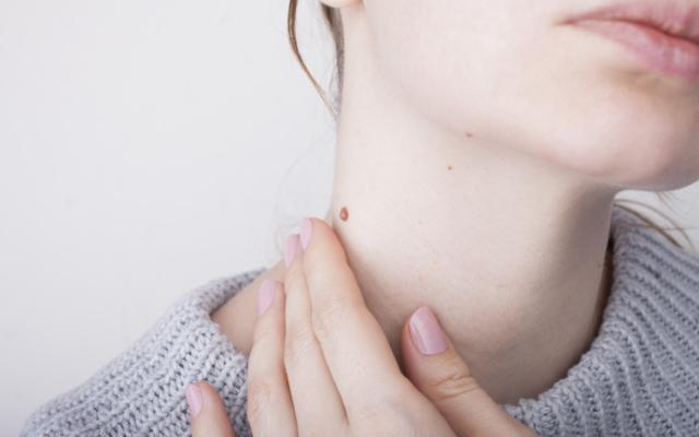 Mujer con verruga en el cuello