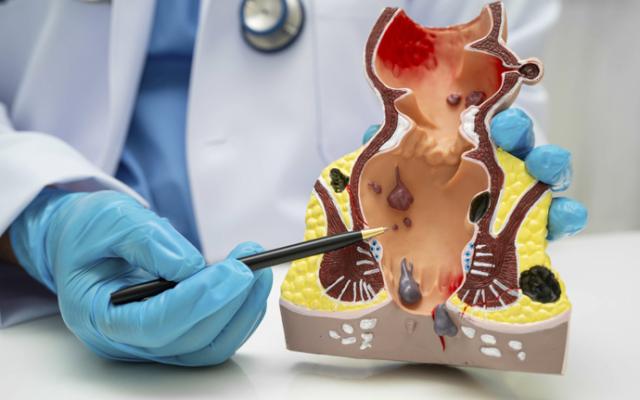 Doctor explica por qué salen las hemorroides