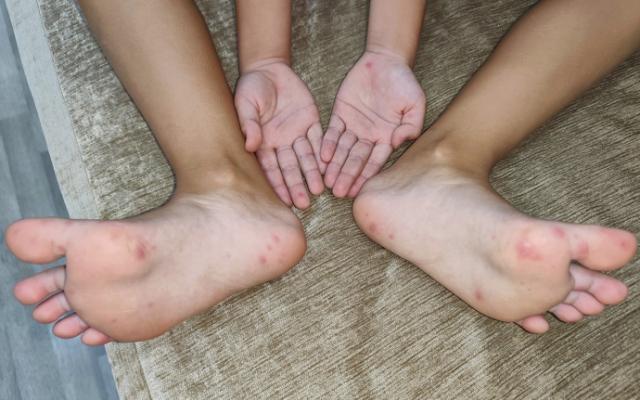 Niño con manchas rojas en los pies