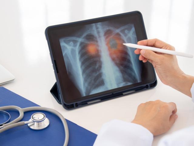 Médico explicando cómo limpiar los pulmones de tabaco con una radiografía.