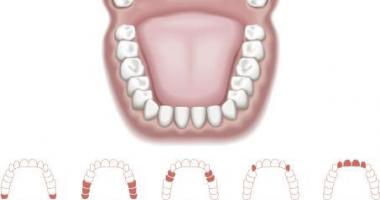 Muelas del juicio y resto de dientes en un diagrama de una boca