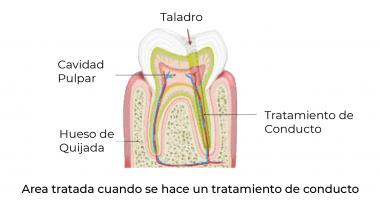 Gráfica de pieza dental mostrando donde se aplica el tratamiento de conducto