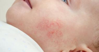 Bebé con dermatitis atópica