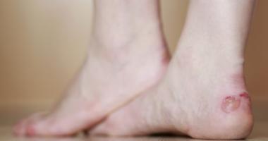 Persona con ampolla en los pies