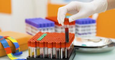 Muestras de sangre para analizar linfocitos y leucocitos altos.