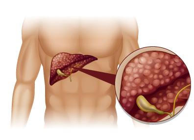 Cirrosis alcohólica: síntomas y tratamiento – Bupa