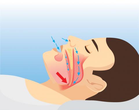 Apnea del sueño