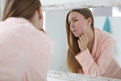 Mujer con acné